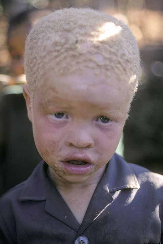 Albino boy